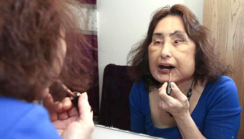 woman who underwent first face transplant in us died