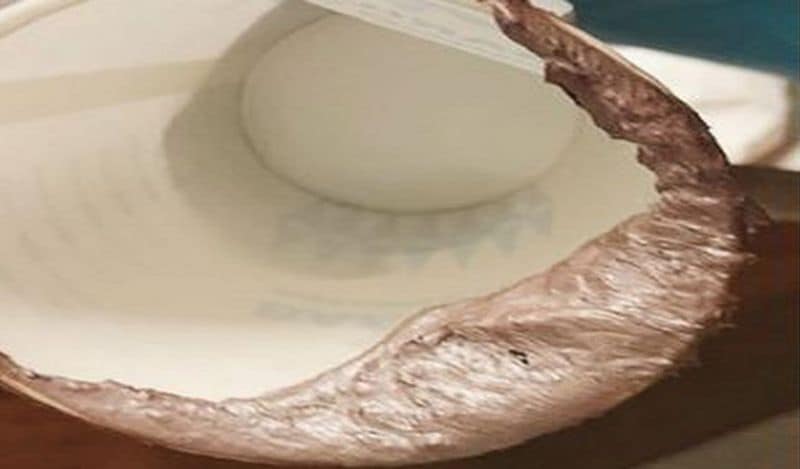 medical mystery womans potty turned into silver shocks doctors kph