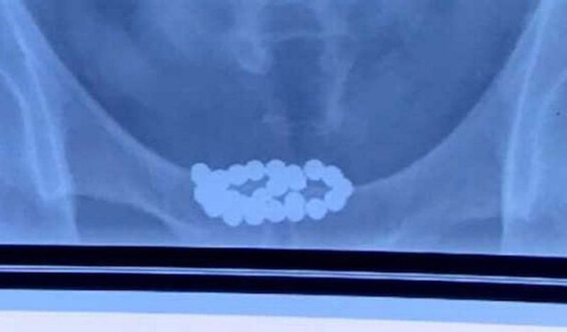 man inserted 29 magnet balls inside private part for fun shocks doctor kph