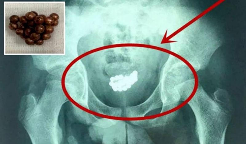 man inserted 29 magnet balls inside private part for fun shocks doctor kph
