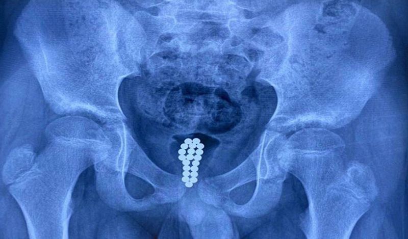 man inserted 29 magnet balls inside private part for fun shocks doctor kph
