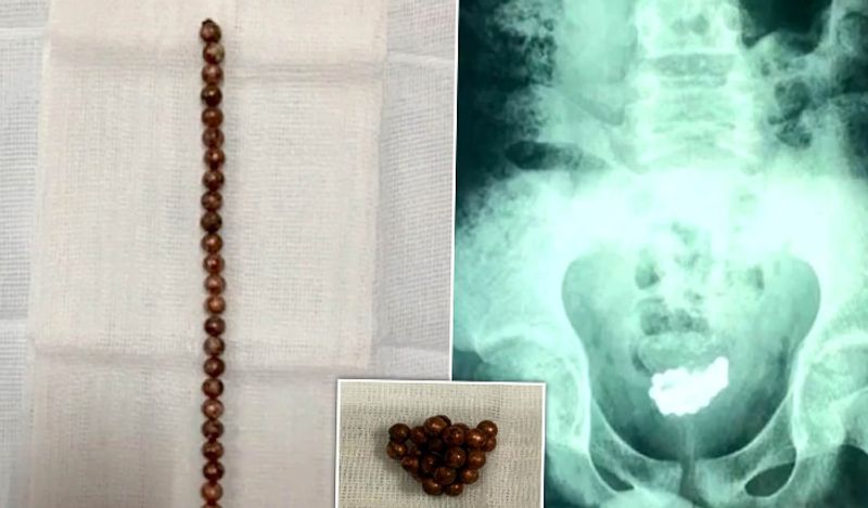 man inserted 29 magnet balls inside private part for fun shocks doctor kph