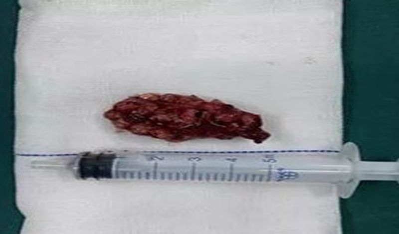 man inserted 29 magnet balls inside private part for fun shocks doctor kph