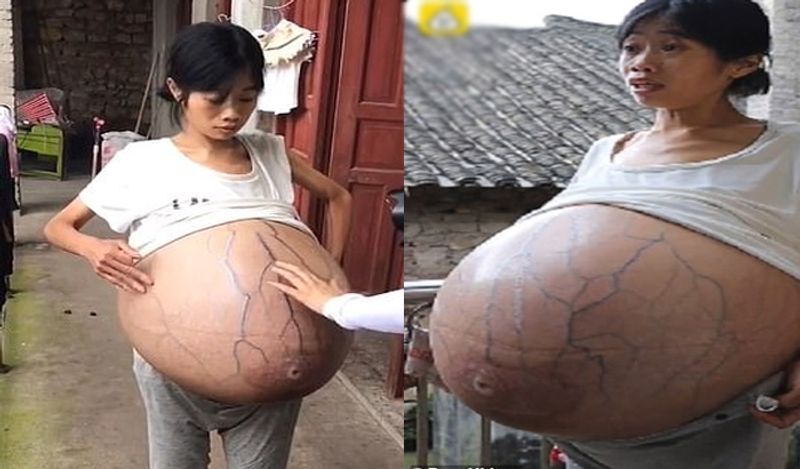 mysterious chinese woman whose belly ballooned uncontrollably from two years now begged for help kph