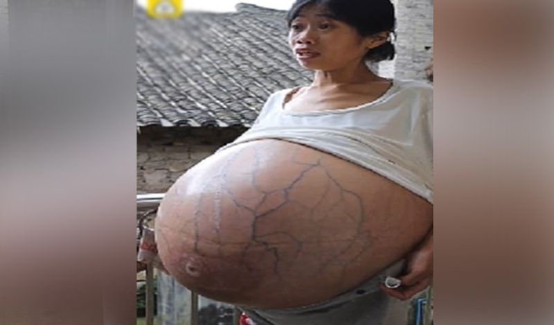 mysterious chinese woman whose belly ballooned uncontrollably from two years now begged for help kph