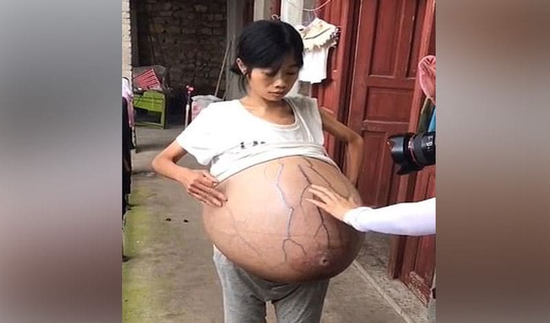 mysterious chinese woman whose belly ballooned uncontrollably from two years now begged for help kph