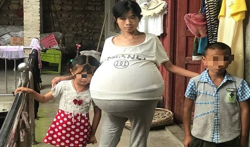 mysterious chinese woman whose belly ballooned uncontrollably from two years now begged for help kph