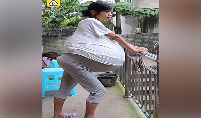 mysterious chinese woman whose belly ballooned uncontrollably from two years now begged for help kph