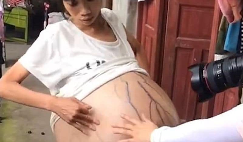 mysterious chinese woman whose belly ballooned uncontrollably from two years now begged for help kph