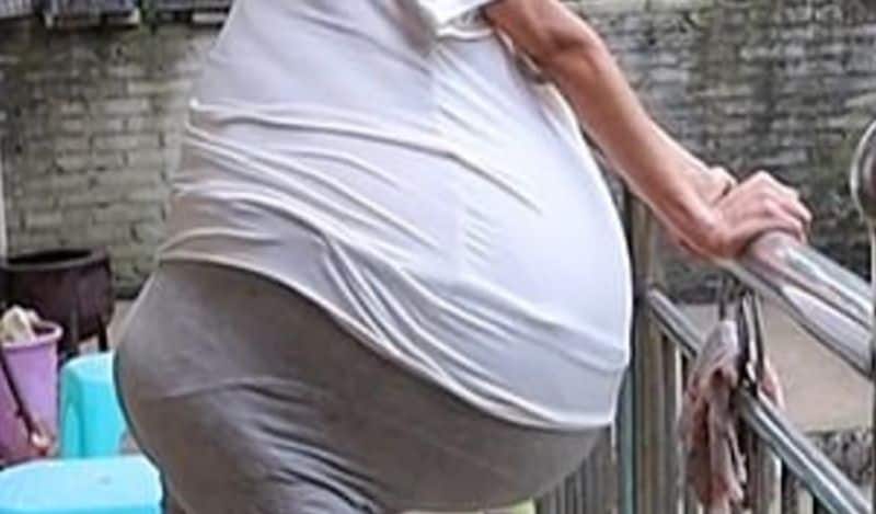 mysterious chinese woman whose belly ballooned uncontrollably from two years now begged for help kph