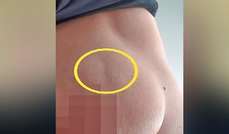 beautiful dimples at woman breast was actually cancer sign kph