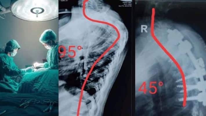 12 year old girl s curved spin rare surgery 12 year old girl s curved spin rare surgery