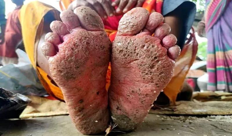 This womans foot got rotten in the flood water get viral from Bihar kph