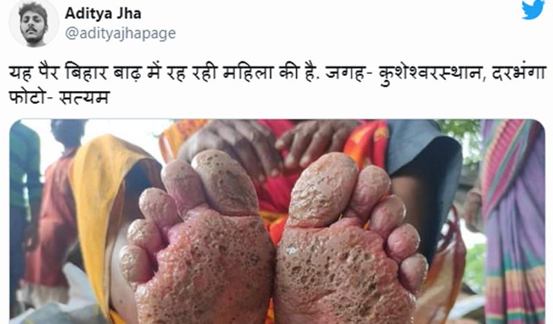 This womans foot got rotten in the flood water get viral from Bihar kph