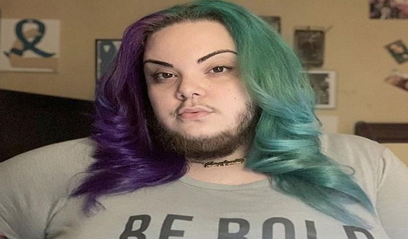 woman with pcos alma torres grow full beard on face