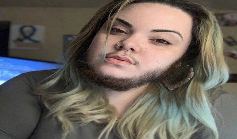 woman with pcos alma torres grow full beard on face