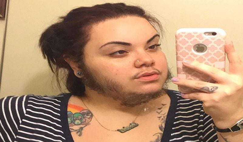 woman with pcos alma torres grow full beard on face