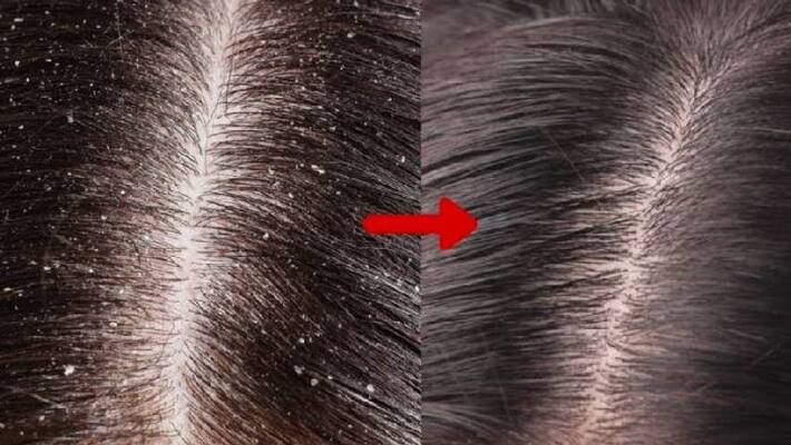 very good hair mask to prevent dandruff very good hair mask to prevent dandruff
