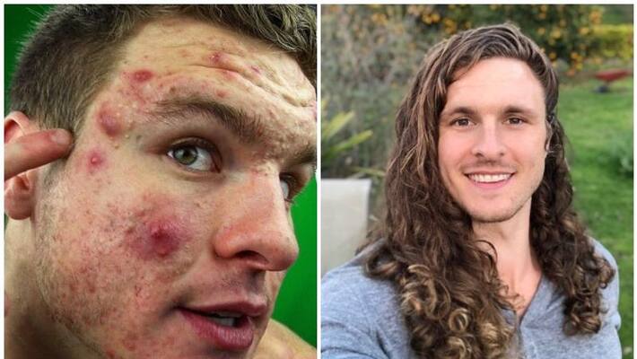 Bodybuilder shares amazing skin transformation after ditching dairy to clear his acne Bodybuilder shares amazing skin transformation after ditching dairy to clear his acne