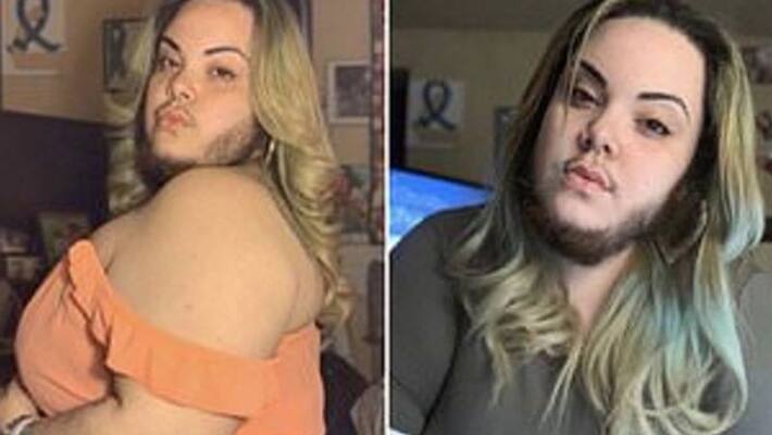 girl with excess facial hair due to pcos girl with excess facial hair due to pcos