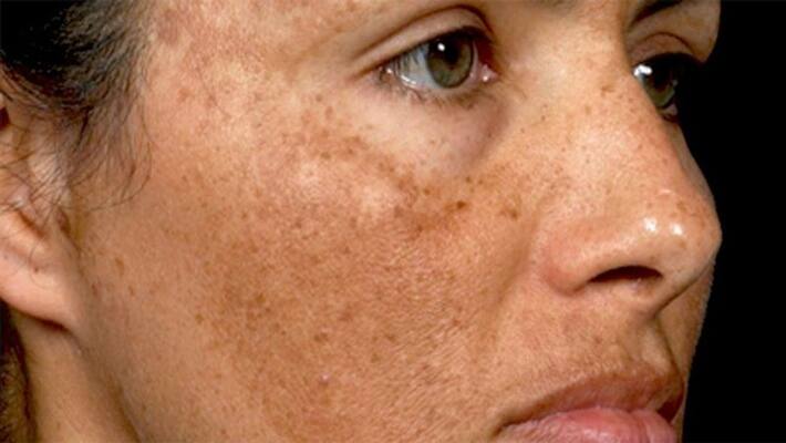 Do not ignore those symptoms it can be the cause of skin cancer ABSC Do not ignore those symptoms it can be the cause of skin cancer ABSC
