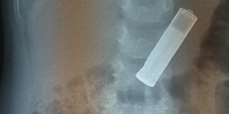 Pencil battery found inside stomach of 3-year-old; doctors perform incision to save life-dbr