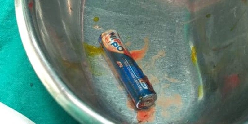 Pencil battery found inside stomach of 3-year-old; doctors perform incision to save life-dbr