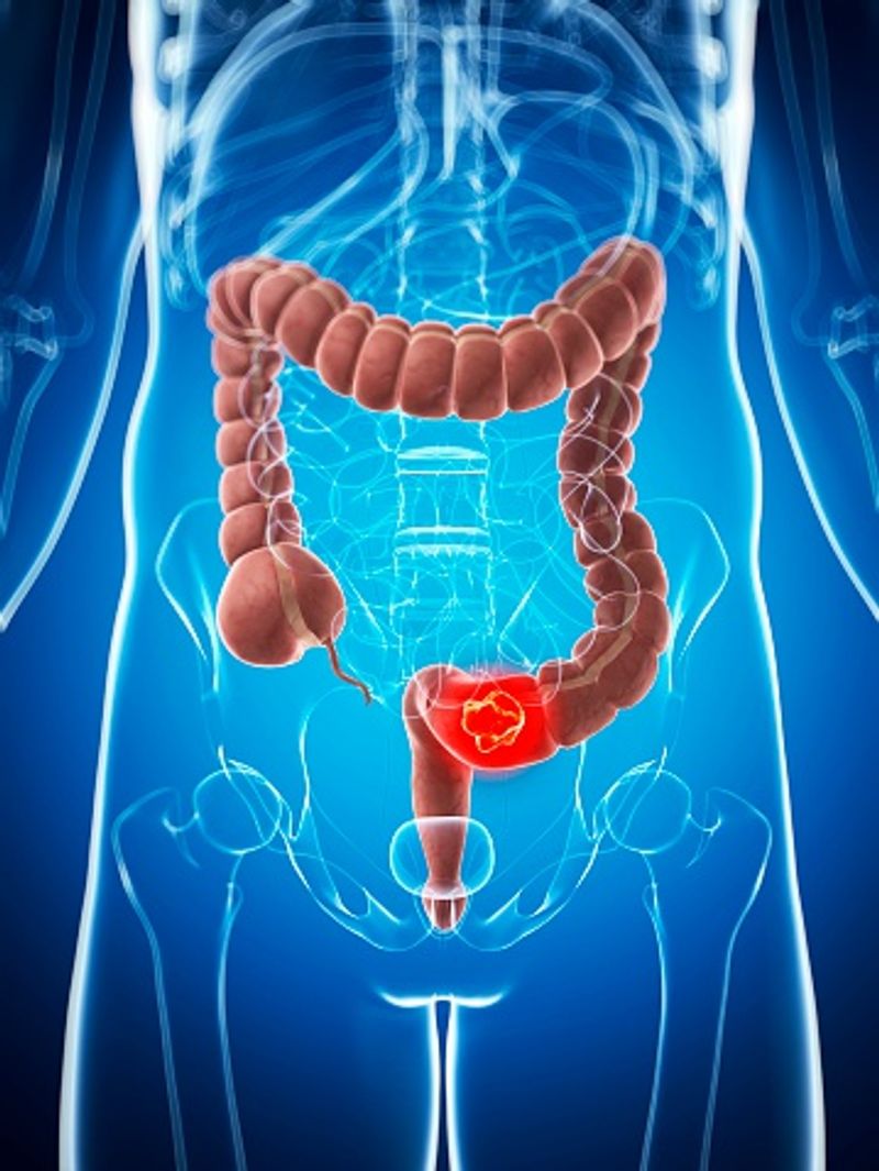 What is Colon Cancer? Know when you should get yourself screened?