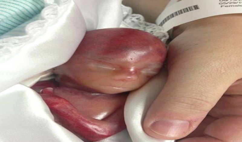 heartbreaking photos of 5 month old fetus killed in the womb american doctors throw it in the trash when it is aborted kph