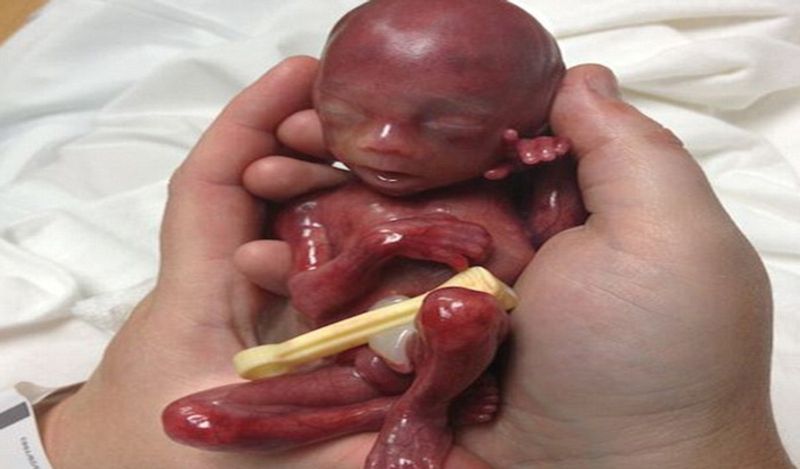 heartbreaking photos of 5 month old fetus killed in the womb american doctors throw it in the trash when it is aborted kph