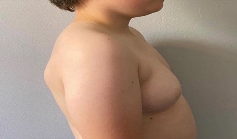 Gynecomastia मे लड़कों की छाती में सूजन आ जाती है। वैसे इससे जान को कोई खतरा नहीं होता लेकिन इसे ठीक करने के लिए मस्टेक्टॉमी नाम की एक प्रक्रिया से गुजरना पड़ता है, जो थोड़ा महंगा होता है। 