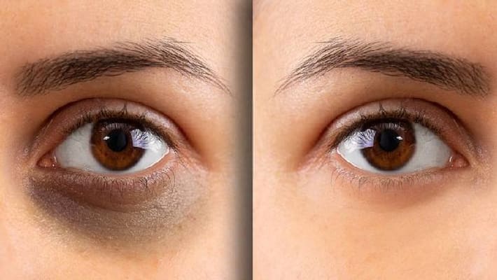 How to get rid of dark circles under eye How to get rid of dark circles under eye