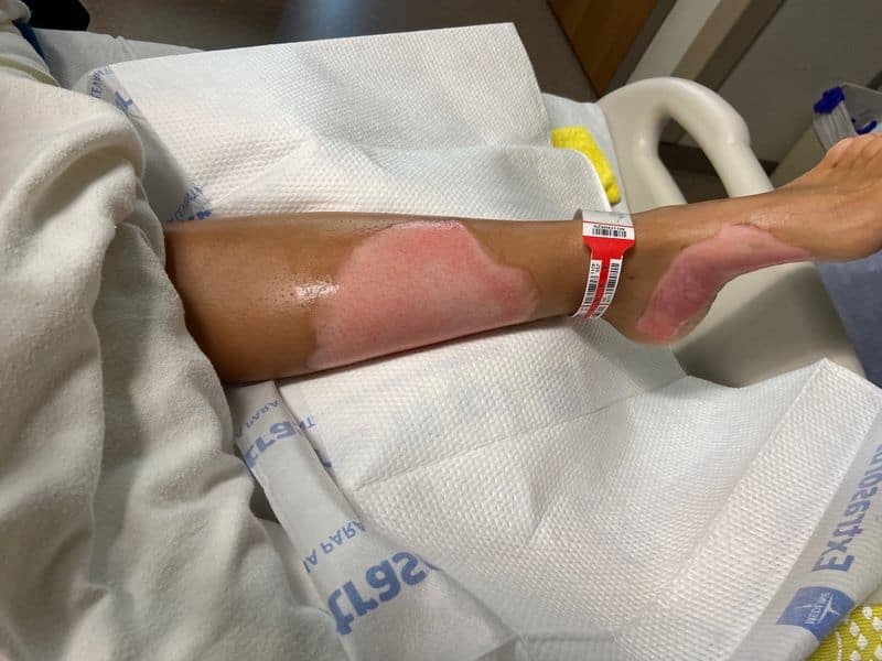 Texas woman severely burned after hand sanitizer catches fire: "My whole body was just consumed in flames"