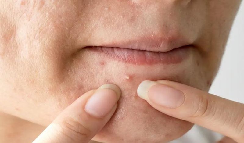 Foods That Make Your Skin Oily And Lifeless dpl