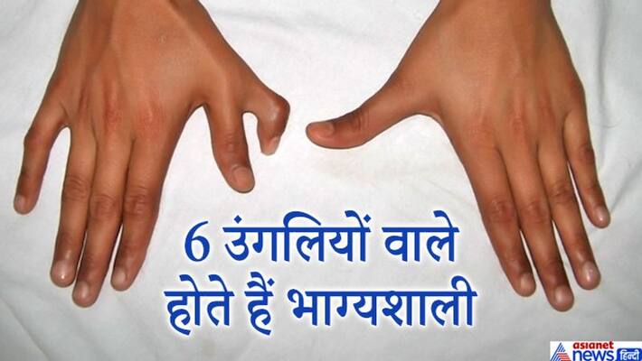 People who have 6 fingers in a hand are considered lucky, know more special things about such people KPI People who have 6 fingers in a hand are considered lucky, know more special things about such people KPI