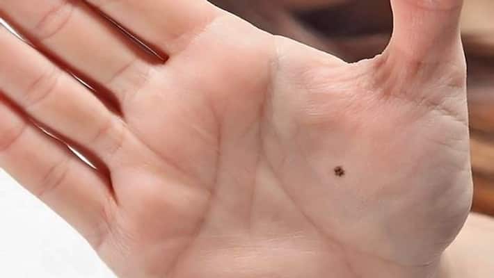Palmistry Mole on palm also tell about future KPI Palmistry Mole on palm also tell about future KPI