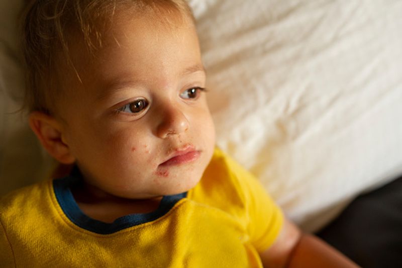 Things Your Patients Need to Know About Hand, Foot, and Mouth Disease dpl