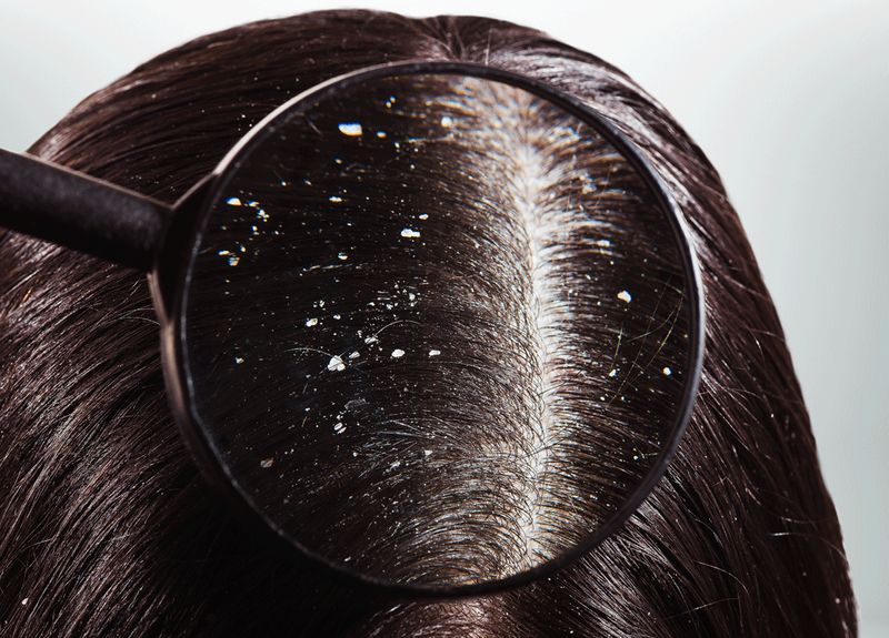These homemade scrubs will help you to get rid of dandruff-snj