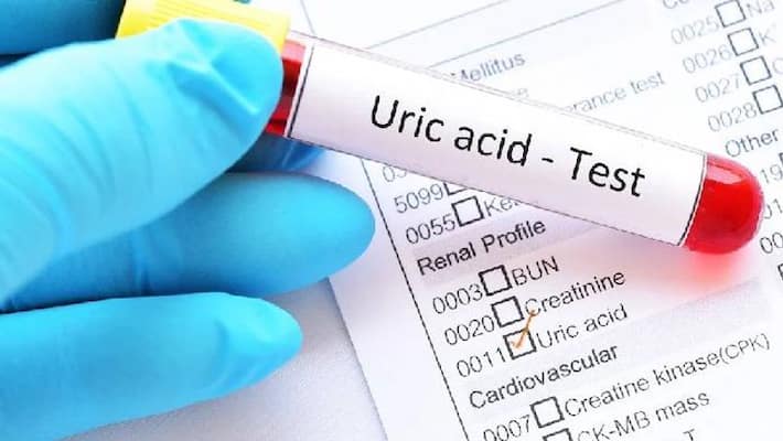 Ayurvedic treatment to reduce uric acid easily BDD Ayurvedic treatment to reduce uric acid easily BDD