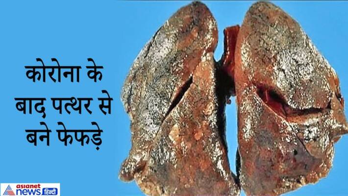 Covid 19, shocking disclosure in autopsy report, lungs like Stone kpa Covid 19, shocking disclosure in autopsy report, lungs like Stone kpa