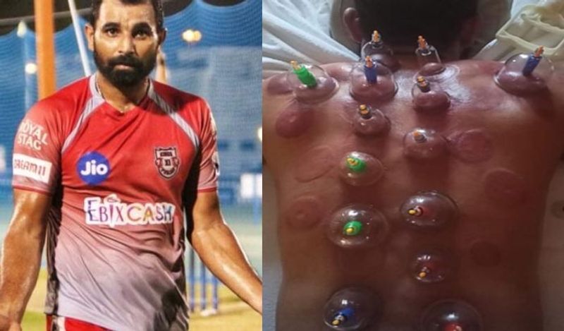 Kings XI Punjab's palyer Mohammed Shami undergoes cupping therapy in Dubai during IPL 2020 spb