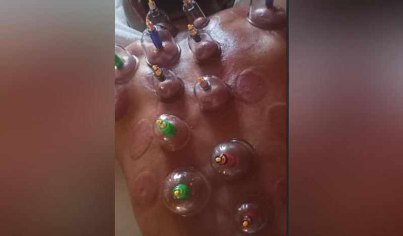 Kings XI Punjab's palyer Mohammed Shami undergoes cupping therapy in Dubai during IPL 2020 spb