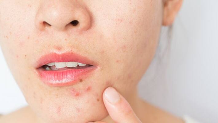 These face packs can be used to get rid of dark spots of acne These face packs can be used to get rid of dark spots of acne