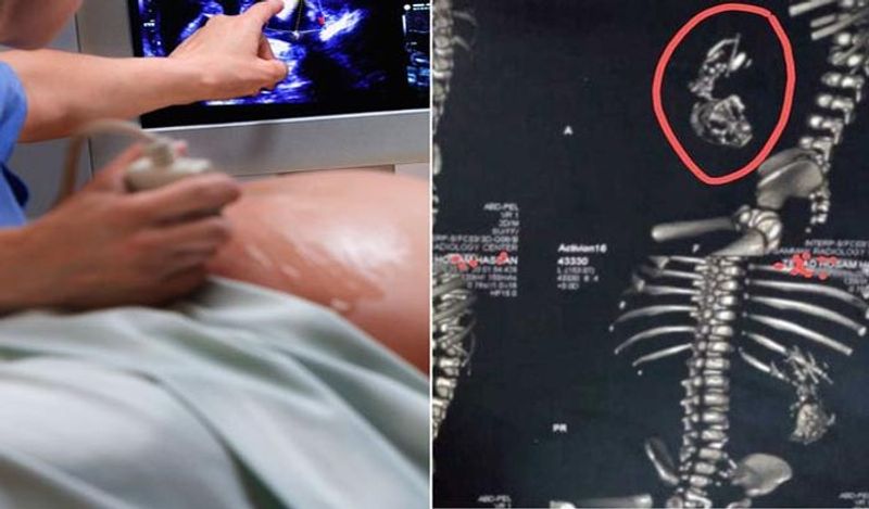 बच्चे की डिलीवरी करवाने वाले डॉक्टर एल मोहसिन ने बताया कि जब महिला 7 महीने की गर्भवती थी, तब ही उन्हें शक हुआ था कि बच्चे के पेट में कुछ अजीब सी चीज मौजूद है। इस कारण जन्म के तुरंत बाद ही उसका अल्ट्रासाउंड करवाया गया। 