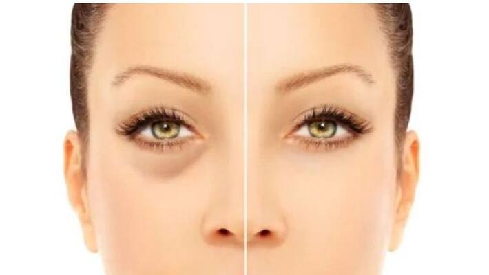 Dark Circles Treatment easily at home BDD Dark Circles Treatment easily at home BDD