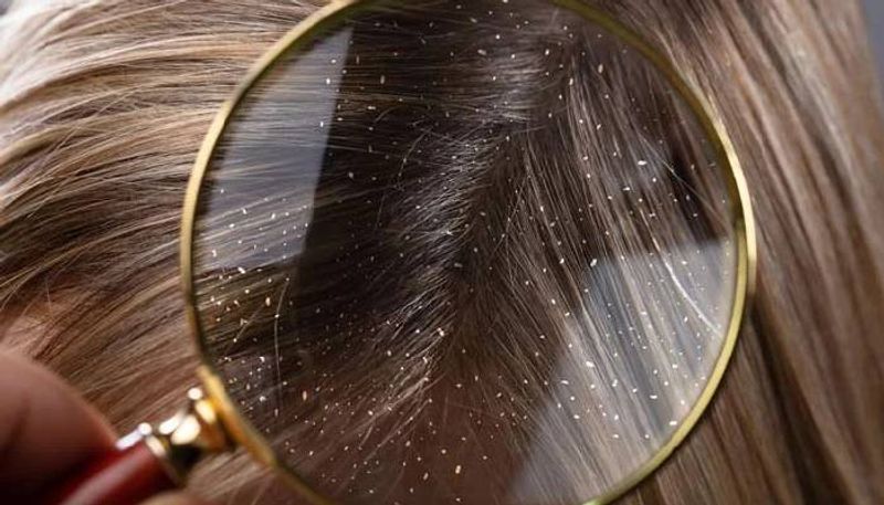 <p style="text-align: justify;">খুশকির সমস্যা দূর করতে কাজে লাগাতে পারেন নিমপাতা। এর জন্য নিমপাতা বেটে নিয়ে চুলের গোড়ায় লাগিয়ে অন্তত ২০ মিনিট রেখে দিতে হবে। এরপর হালকা গরম জলে চুল ধুয়ে শ্যাম্পু করে নিতে হবে।</p>