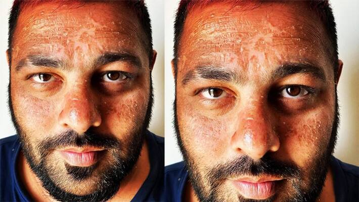 rapper badshah face sunburn badly singer share photo on social media friends and fans shocked KPJ rapper badshah face sunburn badly singer share photo on social media friends and fans shocked KPJ