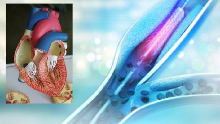 What is coronary angioplasty and how does it work BDD What is coronary angioplasty and how does it work BDD