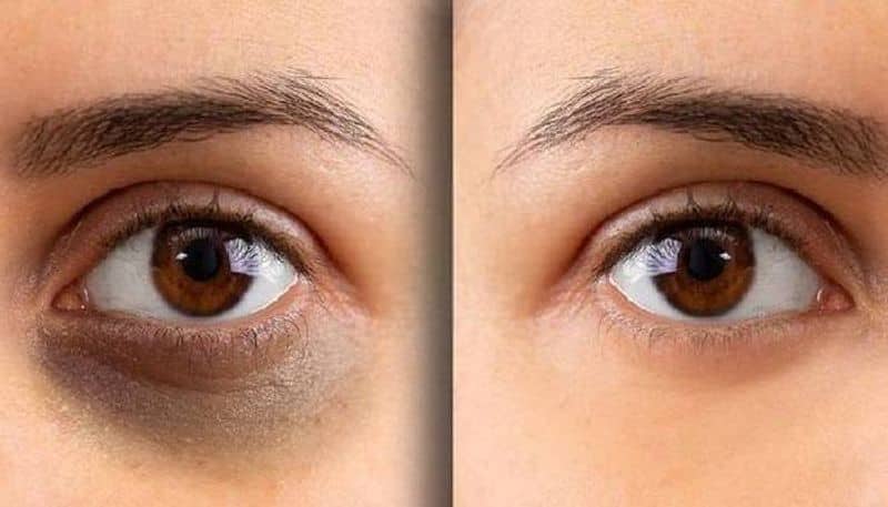 Get rid of the problem of dark circles easily at home before the New Year party BDD