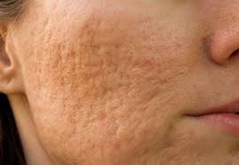 Anti-Acne Treatment: Take 1tsp glycerine, 1tsp Fuller's Earth, a pinch of camphor and a tsp of witch-hazel in a bowl and mix them well. Apply the mixture on the affected area. Leave on till dry and wash off with normal water.
NOTE: Asianet News humbly requests everyone to wear masks, sanitize, maintain social distancing and get vaccinated as soon as eligible. Together we can and will break the chain #ANCares #IndiaFightsCorona